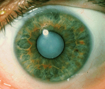 Wat is cataract, leidend tot blindheid
