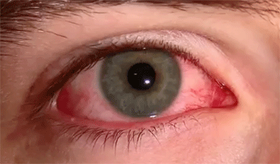 B2 tekort bij bloeddoorlopen ogen