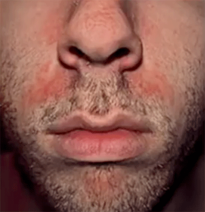 Roodheid bij de neus, voorhoofd of wangen - vit B6 Tekort