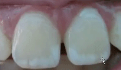 Tandvlekjes bij te veel fluoride